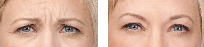 Botox