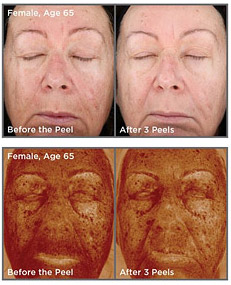 chemical peel, Custom Chemical Peels
