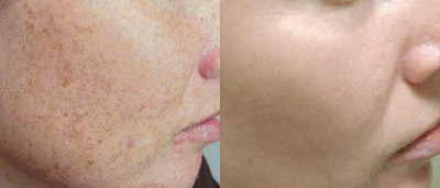 ipl laser, IPL Photofacial &#8211; Skin Revitalization