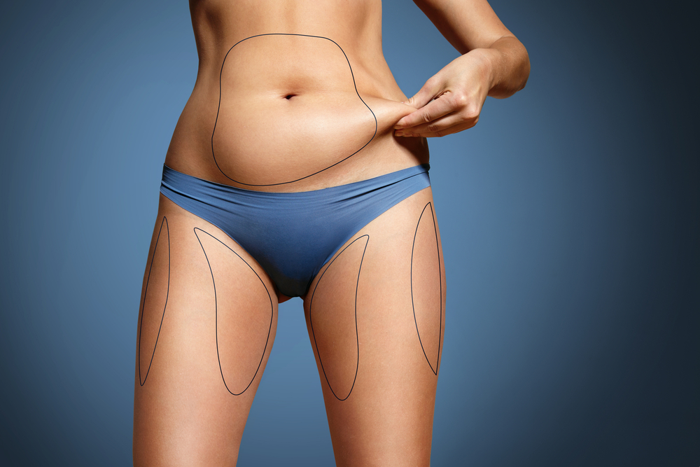 How Much Fat Can Be Removed With Smart Lipo Ellsmore chiera