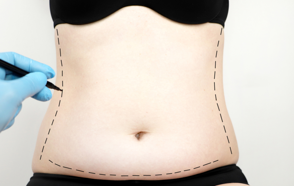The Scope Blog - Which Type of Tummy Tuck Is Right for Me
