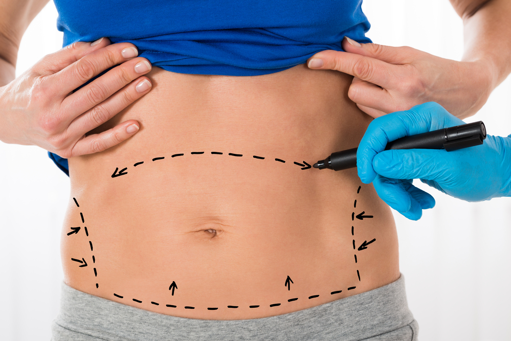 The Complete Guide To Liposuction In Mexico, 59% OFF